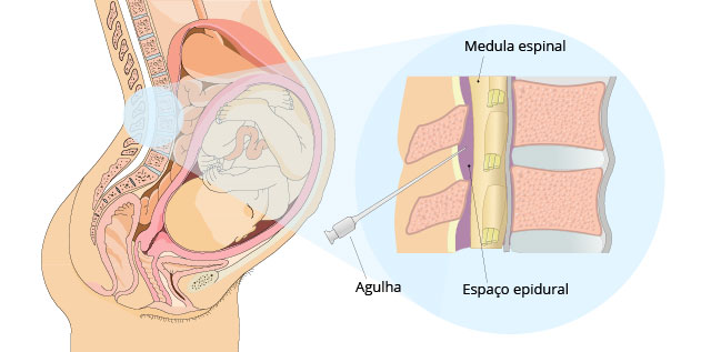 Administração da anestesia epidural