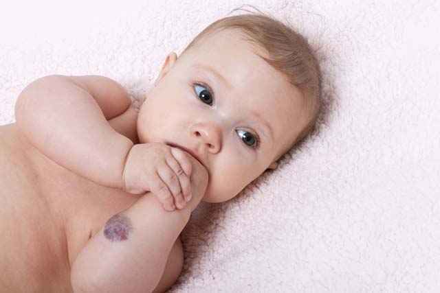 Bebê com hemangioma no braço